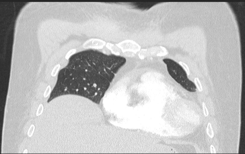 Aspirated tooth (Radiopaedia 28584-28844 Axial lung window 36).jpg