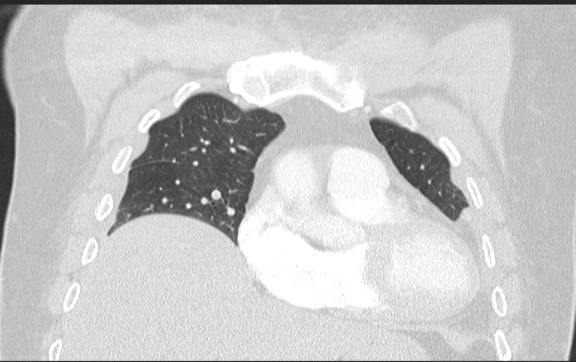 Aspirated tooth (Radiopaedia 28584-28844 Axial lung window 40).jpg