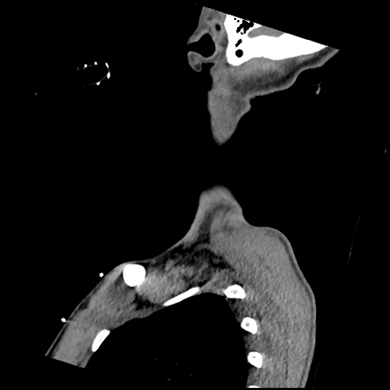 Atlanto-occipital dissociation (Traynelis type 1), C2 teardrop fracture, C6-7 facet joint dislocation (Radiopaedia 87655-104061 D 77).jpg
