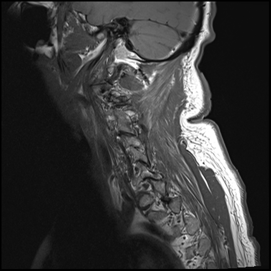 File:Atlas (type 3b subtype 1) and axis (Anderson and D'Alonzo type 3, Roy-Camille type 2) fractures (Radiopaedia 88043-104610 Sagittal T1 13).jpg