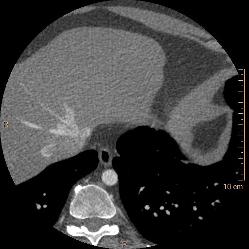 Atrial septal defect (upper sinus venosus type) with partial anomalous pulmonary venous return into superior vena cava (Radiopaedia 73228-83961 A 259).jpg