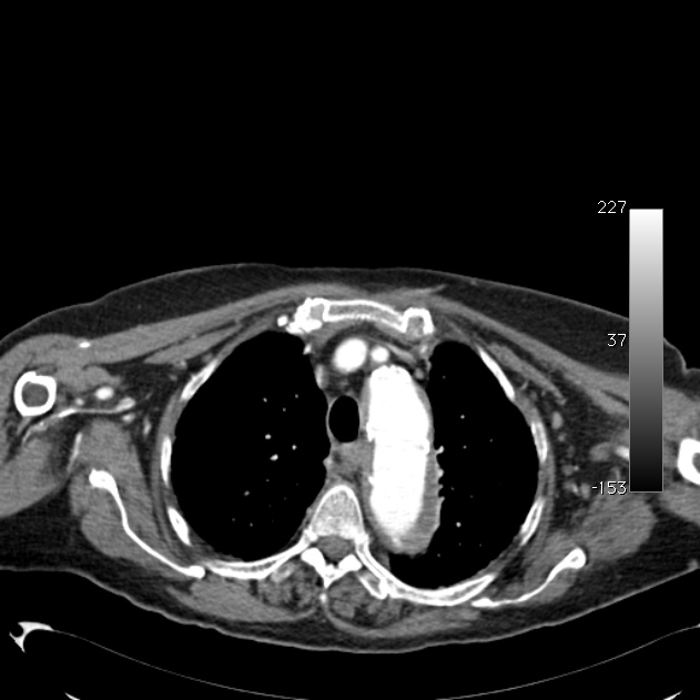 Atypical dissection of the thoracic aorta (Radiopaedia 10975-11393 A 14).jpg