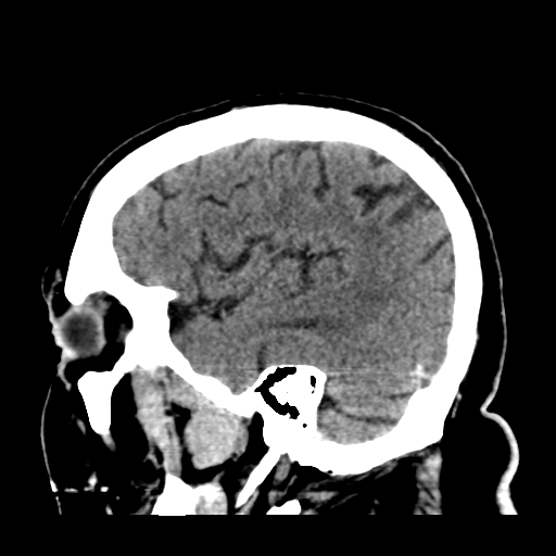 Atypical meningioma (WHO grade II) with brain invasion (Radiopaedia 57767-64728 Sagittal C+ 40).png