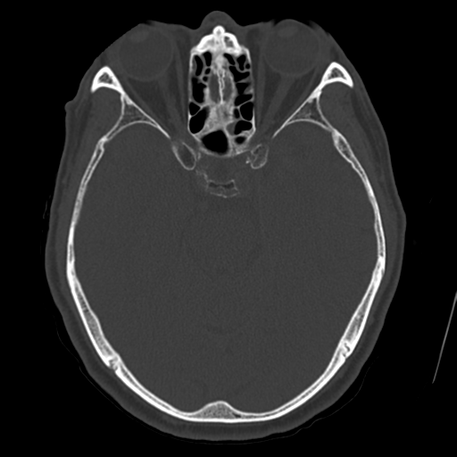 Atypical meningioma with skull invasion (Radiopaedia 34357-35649 Axial bone window 31).png