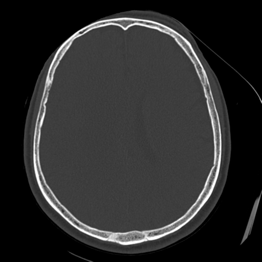 Atypical meningioma with skull invasion (Radiopaedia 34357-35649 Axial bone window 50).png