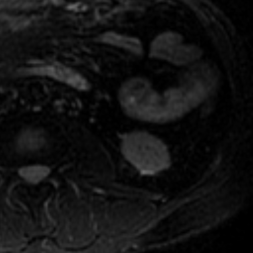 File:Atypical renal cyst on MRI (Radiopaedia 17349-17046 Axial T2 fat sat 20).jpg