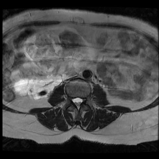 File:Atypical retroperitoneal lymphocoeles with large leiomyoma of uterus (Radiopaedia 32084-33027 Axial T2 3).jpg