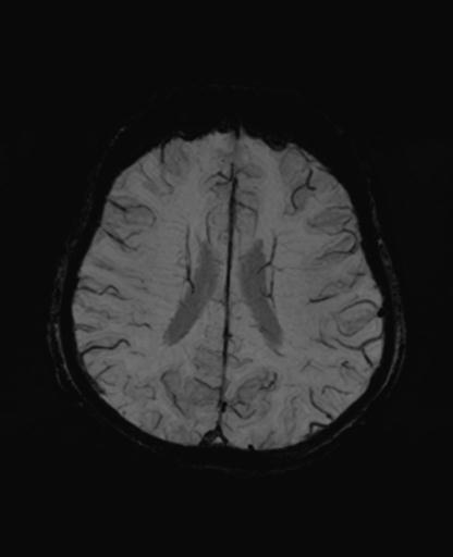Autoimmune limbic encephalitis (Radiopaedia 30363-31005 SWI - mIP 49).jpg