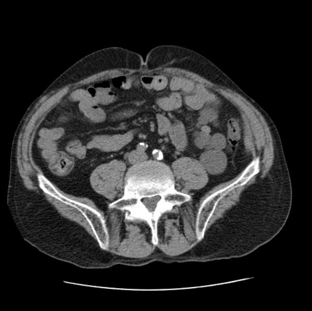 Autosomal dominant polycystic kidney disease (Radiopaedia 27851-28094 Axial non-contrast 86).jpg