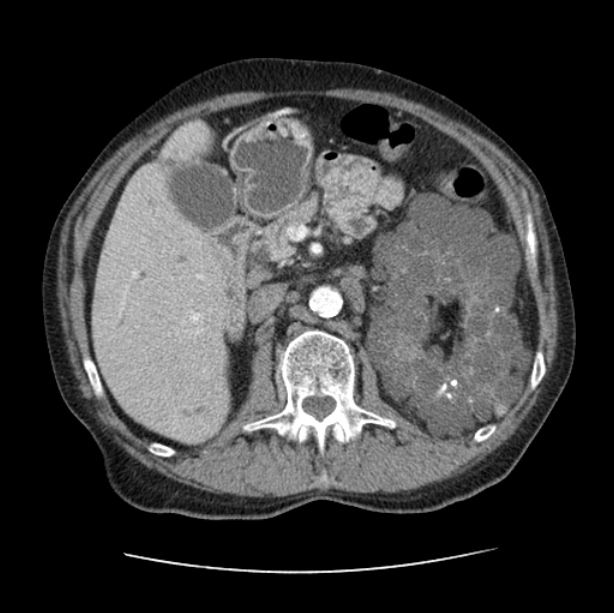 Autosomal dominant polycystic kidney disease (Radiopaedia 27851-28094 B 68).jpg