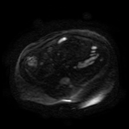 Autosomal dominant polycystic kidney disease (Radiopaedia 50259-55611 Axial DWI 106).jpg