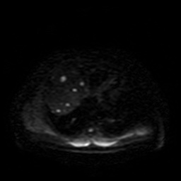 Autosomal dominant polycystic kidney disease (Radiopaedia 50259-55611 Axial DWI 3).jpg