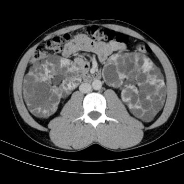 Autosomal dominant polycystic kidney disease (Radiopaedia 66349-75582 B 49).jpg