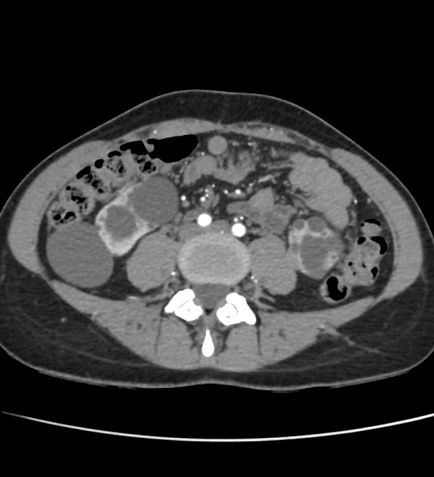 Autosomal dominant polycystic kidney disease - early onset (Radiopaedia 40734-43387 B 48).jpg