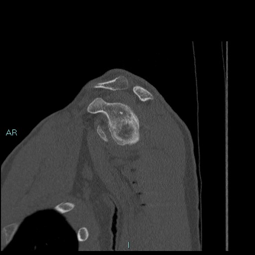 Avascular necrosis after fracture dislocations of the proximal humerus (Radiopaedia 88078-104655 Sagittal bone window 30).jpg
