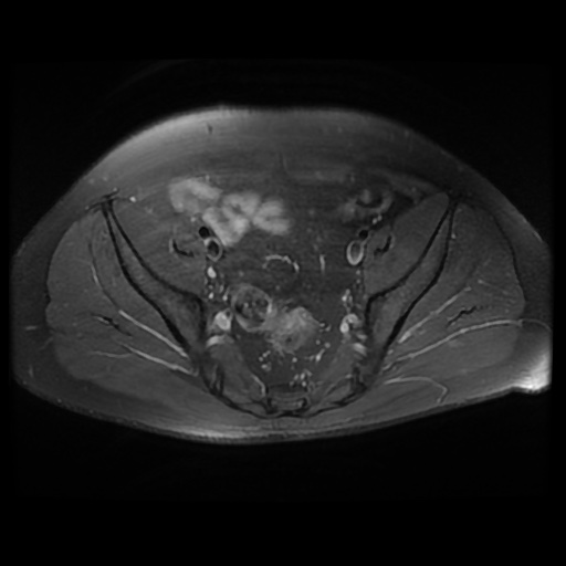 File:Avascular necrosis of the hip (Radiopaedia 61503-69465 Axial PD fat sat 8).jpg