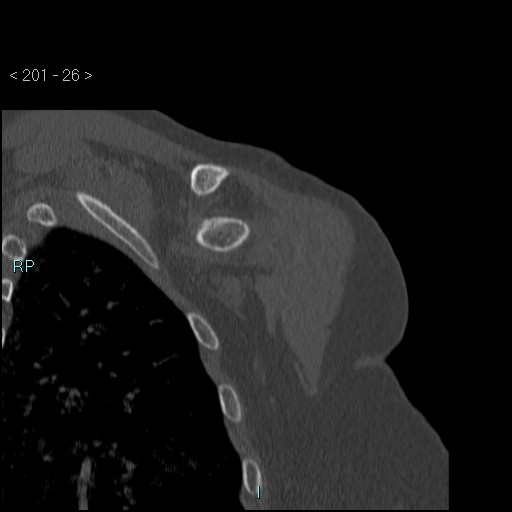 Avascular necrosis of the shoulder - Cruess stage I (Radiopaedia 77674-89887 Coronal bone window 25).jpg