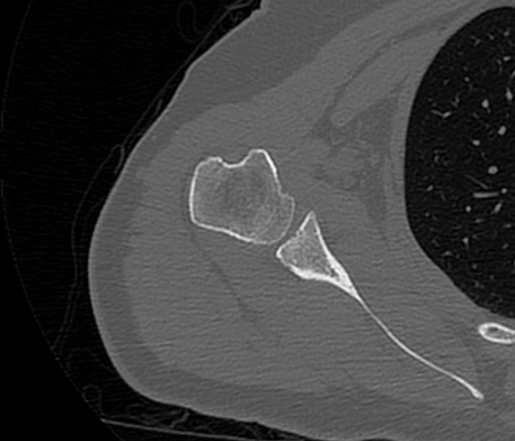 Avulsion fracture - greater tuberosity of humerus (Radiopaedia 71216-81514 Axial bone window 48).jpg