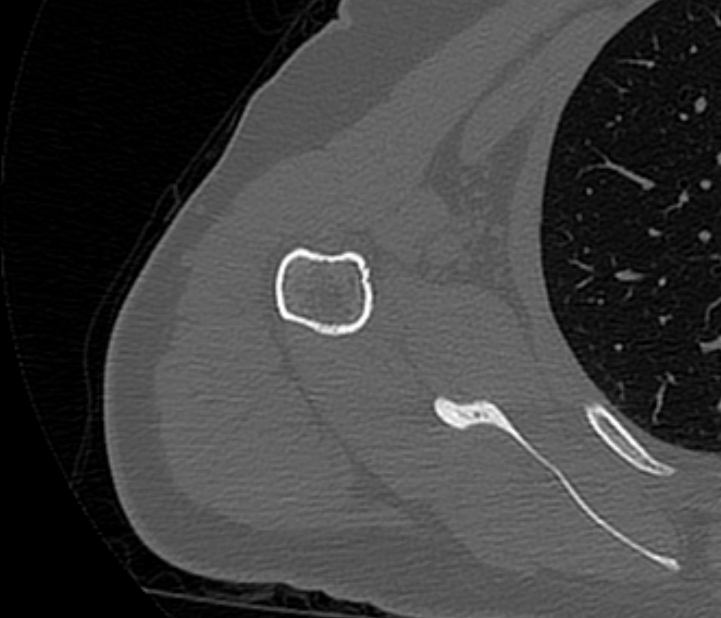 Avulsion fracture - greater tuberosity of humerus (Radiopaedia 71216-81514 Axial bone window 57).jpg