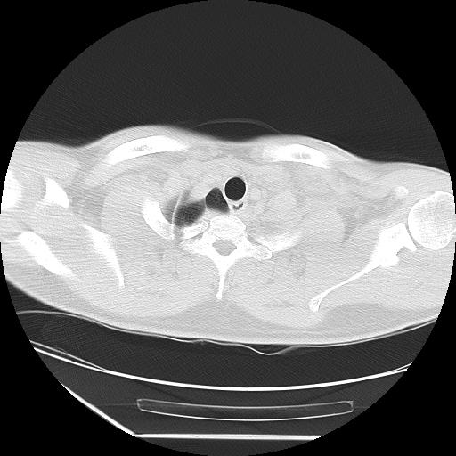 Azygos fissure (Radiopaedia 88181-104784 Axial lung window 2).jpg
