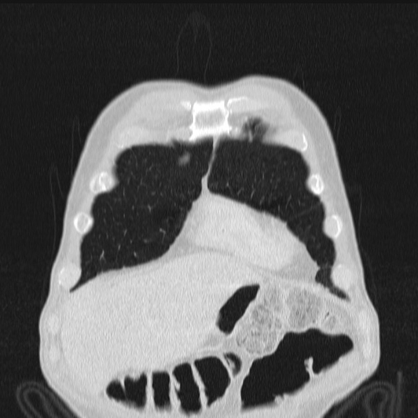 Azygos lobe (Radiopaedia 38259-40275 Coronal lung window 13).jpg