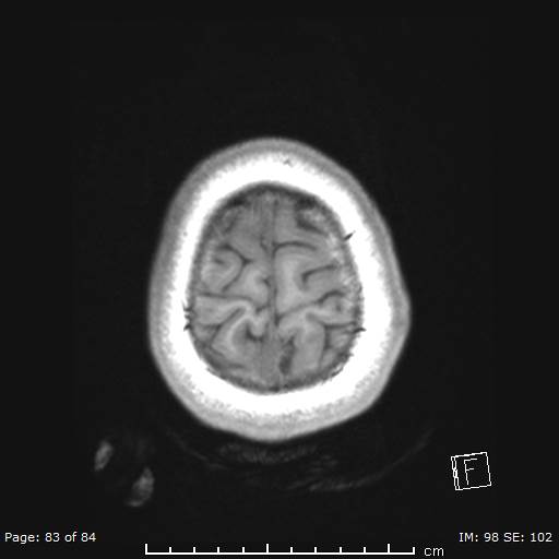 Balo concentric sclerosis (Radiopaedia 61637-69636 Axial T1 83).jpg