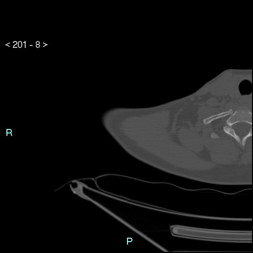 Bankart lesion with glenoid bone defect - assessment TC with PICO method (Radiopaedia 42855-93901 Axial bone window 7).jpg