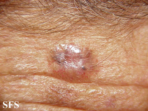 Basal Cell Carcinoma (Dermatology Atlas 81).jpg