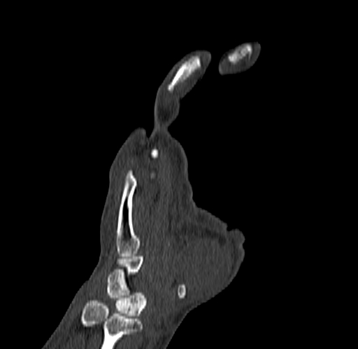 Base of 2nd metacarpal fracture (Radiopaedia 73741-84544 Coronal bone window 33).jpg