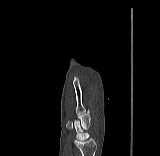 Base of 2nd metacarpal fracture (Radiopaedia 73741-84544 Sagittal bone window 33).jpg