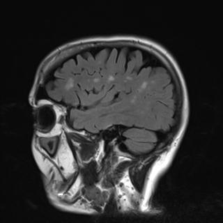 File:Base of skull chondrosarcoma (Radiopaedia 30410-31070 Sagittal FLAIR 3).jpg