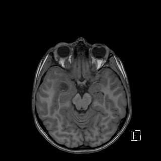 File:Base of skull rhabdomyosarcoma (Radiopaedia 32196-33142 Axial T1 20).jpg