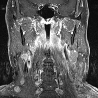 File:Base of tongue squamous cell carcinoma (Radiopaedia 31174-31884 E 4).jpg