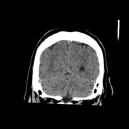 Basilar and bilateral vertebral artery occlusion (Radiopaedia 45592-49723 Coronal 51).png