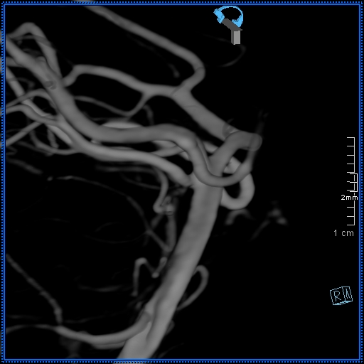 Basilar artery perforator aneurysm (Radiopaedia 82455-99524 3D Left VA 58).jpg