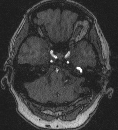 Basilar tip aneurysm (Radiopaedia 26504-26632 MRA 44).jpg