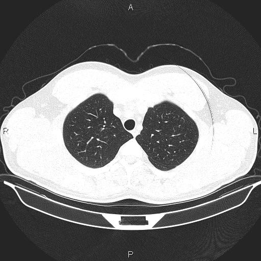 Beam hardening and ring artifacts (Radiopaedia 85323-100915 Axial lung window 19).jpg