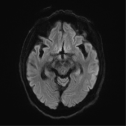 Behavioral variant frontotemporal dementia and late onset schizophrenia (Radiopaedia 52197-58083 Axial DTI Trace W 38).png