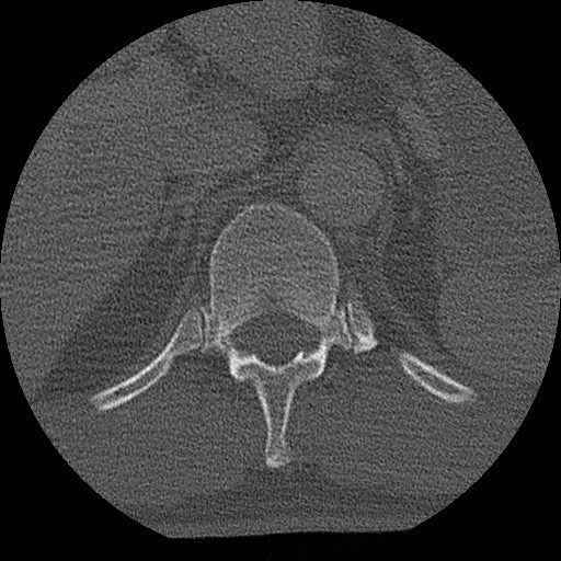Benign post-traumatic pseudopneumoperitoneum (Radiopaedia 71199-81495 Axial bone window 166).jpg