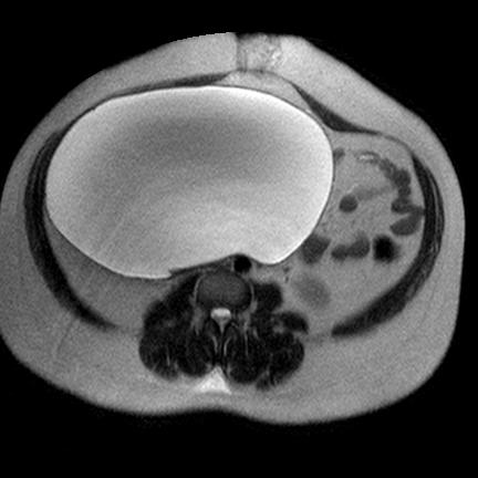 File:Benign seromucinous cystadenoma of the ovary (Radiopaedia 71065-81300 Axial T2 3).jpg