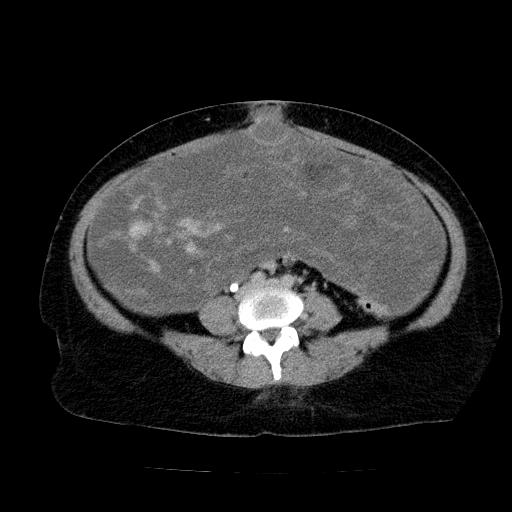 Benign spindle cell tumor - abdominopelvic (Radiopaedia 61300-69212 Axial C+ delayed 39).jpg