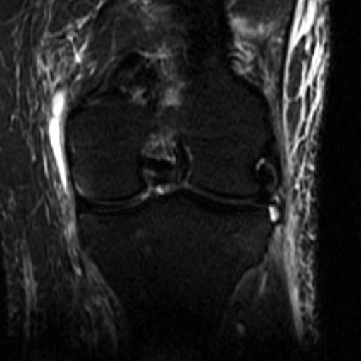 File:Biceps femoris distal tendon avulsion (Radiopaedia 15109-14987 Coronal STIR 4).jpg