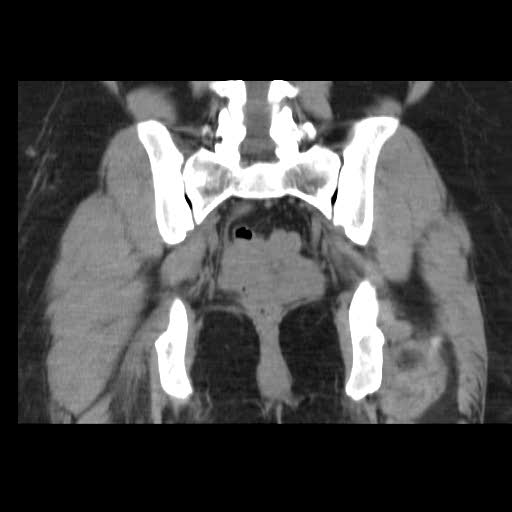 File:Bicornuate uterus (MRI) (Radiopaedia 49206-54296 Coronal 10).jpg