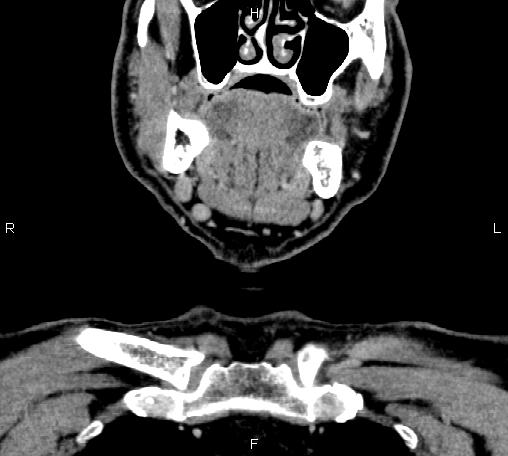 File:Bilateral Warthin tumors (Radiopaedia 84034-99263 C 12).jpg