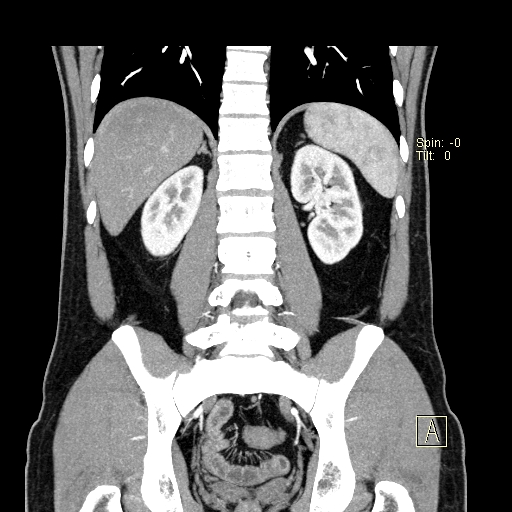 File:Bilateral accessory renal arteries with mild pelvi-ureteric junction (PUJ) obstruction (Radiopaedia 66357-75596 B 39).jpg