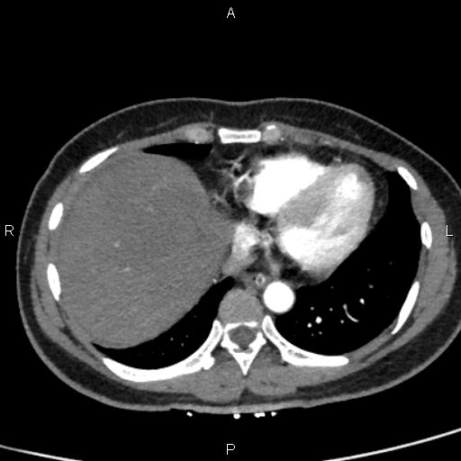 Bilateral adrenal gland hyperenhancement in pancreatitis (Radiopaedia 86642-102753 B 9).jpg
