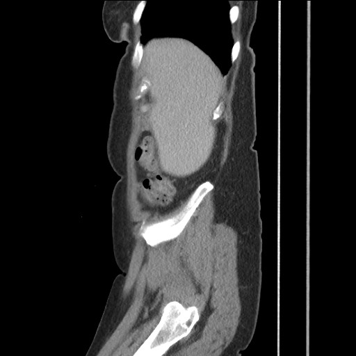 Bilateral adrenal granulocytic sarcomas (chloromas) (Radiopaedia 78375-91007 C 31).jpg
