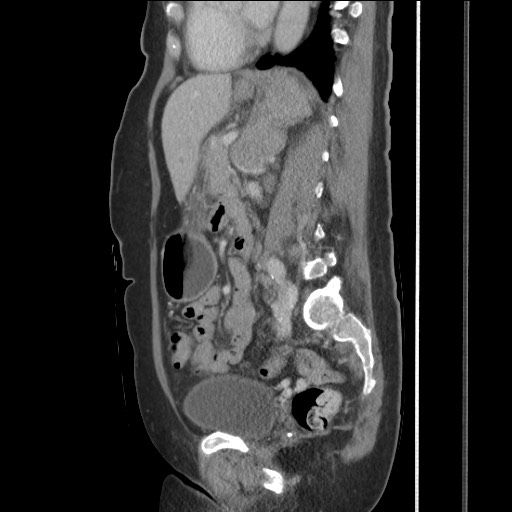 Bilateral adrenal granulocytic sarcomas (chloromas) (Radiopaedia 78375-91007 C 84).jpg