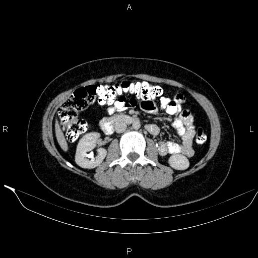 Bilateral adrenal myelolipoma (Radiopaedia 63058-71535 Axial C+ delayed 60).jpg