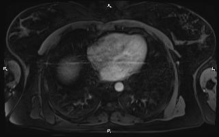 File:Bilateral adrenal myelolipoma (Radiopaedia 63058-71537 Axial T1 C+ fat sat 5).jpg
